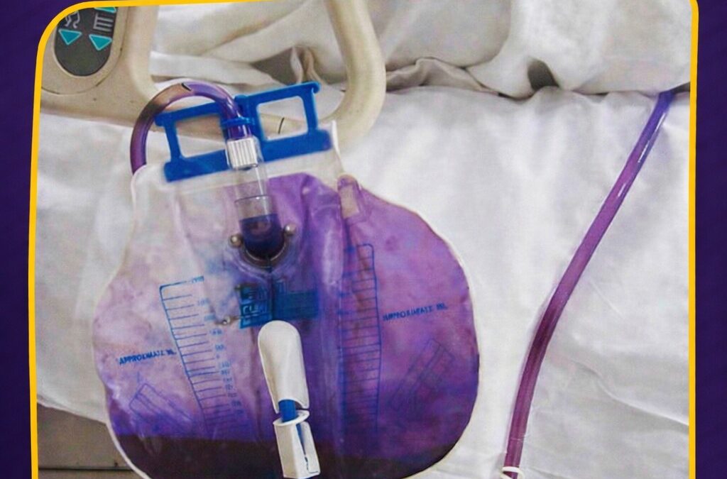 Urina roxa na bolsa coletora assusta — mas também pode ser uma pista importante.