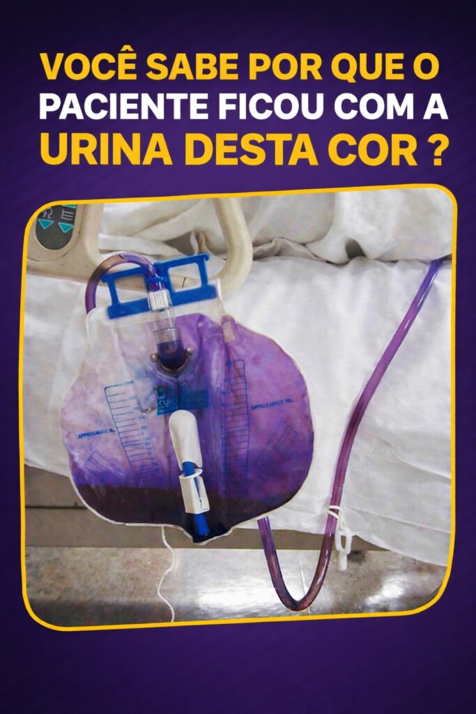 Urina roxa na bolsa coletora assusta — mas também pode ser uma pista importante.